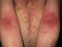 Kollarda Kaşıntı Belirtileri ve Tedavisi