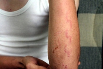 Çatlak Kol Belirtileri ve Tedavisi